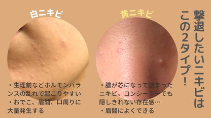 YANHEE アクネクリーム10g