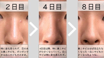 YANHEE アクネクリーム10g